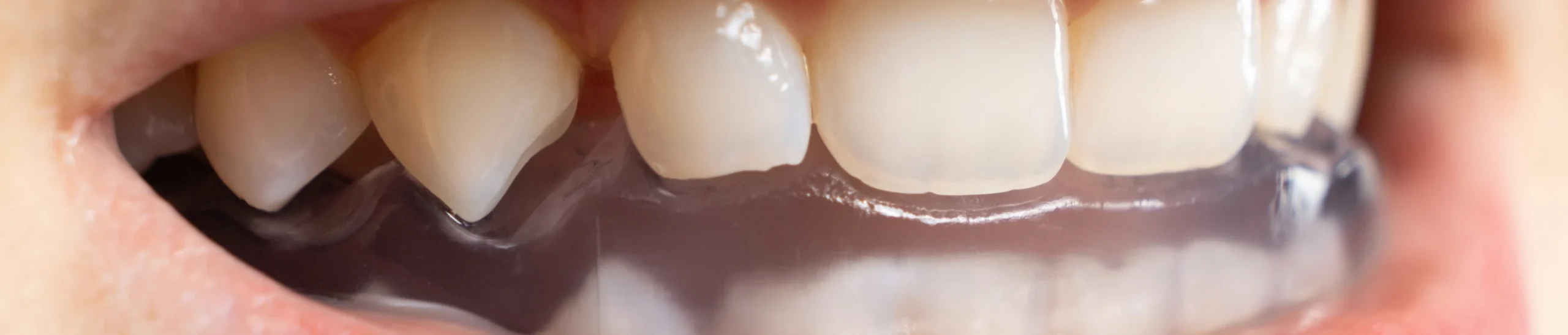 agenesie dentaire scaled Problème articulaire Orthodontiste Altkirch | Dr Marie Saive & Dr Olivier Saive