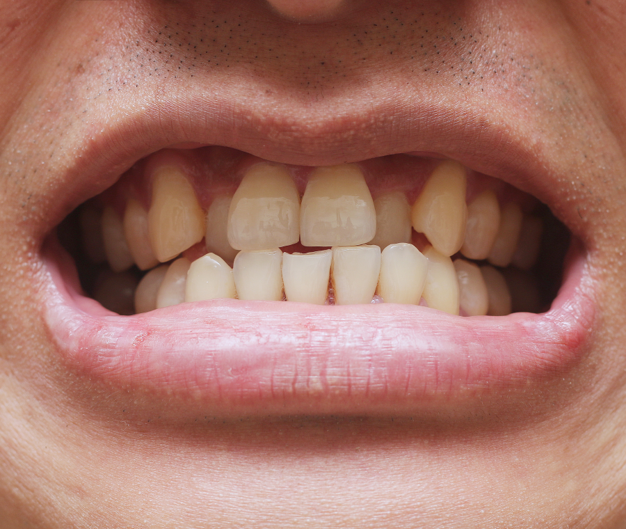 appareil dentaire ceramique Encombrement dentaire, arcade dentaire étroite, manque de place Orthodontiste Altkirch | Dr Marie Saive & Dr Olivier Saive