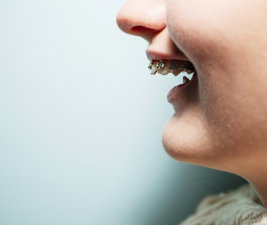 appareil dentaire metal ceramique Incisives supérieures trop en avant, habitude de succion persistante, béance incisive, morsure palatine Orthodontiste Altkirch | Dr Marie Saive & Dr Olivier Saive