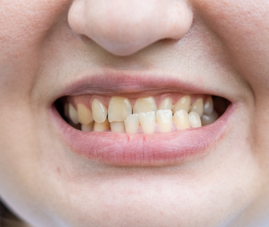 appareils amovibles orthodontiste Mâchoire inférieure trop en arrière ou trop en avant Orthodontiste Altkirch | Dr Marie Saive & Dr Olivier Saive