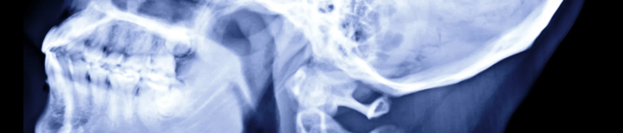 arcade dentaire etroite scaled Mâchoire inférieure trop en arrière ou trop en avant Orthodontiste Altkirch | Dr Marie Saive & Dr Olivier Saive