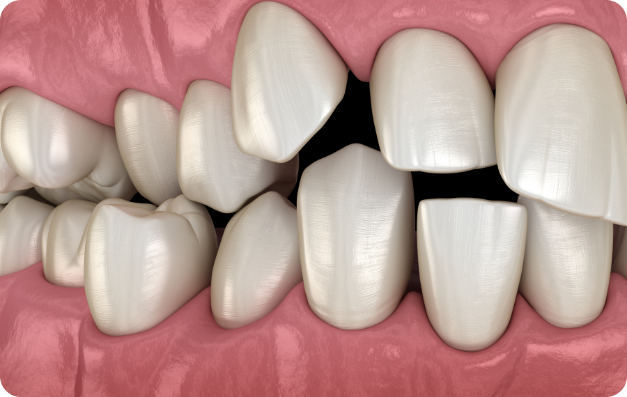 bagues linguales orthosaive orthodontie bagues linguales orthosaive orthodontie Encombrement dentaire, arcade dentaire étroite, manque de place Orthodontiste Altkirch | Dr Marie Saive & Dr Olivier Saive