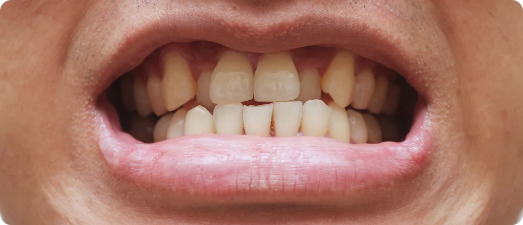 disjoncteur maxillaire altkirch cabinet disjoncteur maxillaire altkirch cabinet Encombrement dentaire, arcade dentaire étroite, manque de place Orthodontiste Altkirch | Dr Marie Saive & Dr Olivier Saive