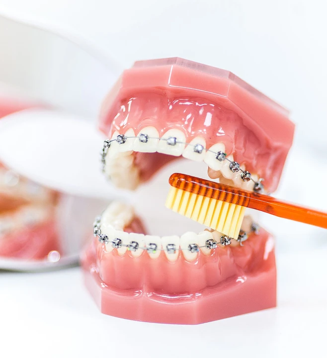 encombrement dentaire altkirch orthodontie Hygiène bucco-dentaire Orthodontiste Altkirch | Dr Marie Saive & Dr Olivier Saive