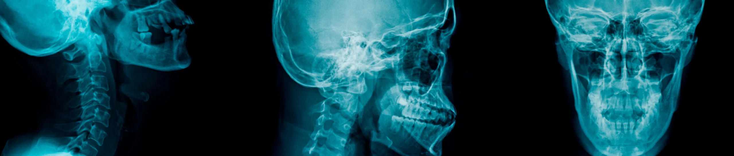 encombrement dentaire orthodontie scaled Inversé dentaire et déviation de la mâchoire inférieure Orthodontiste Altkirch | Dr Marie Saive & Dr Olivier Saive