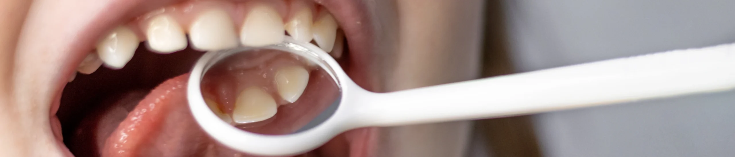 habitude succion scaled Incisives supérieures trop en avant, habitude de succion persistante, béance incisive, morsure palatine Orthodontiste Altkirch | Dr Marie Saive & Dr Olivier Saive