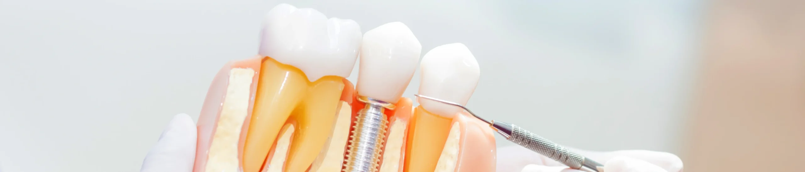 incisives avancees scaled Prise en charge multi-disciplinaire: réhabilitation pré-prothétique, pré-implantaire, pré-chirurgicale Orthodontiste Altkirch | Dr Marie Saive & Dr Olivier Saive