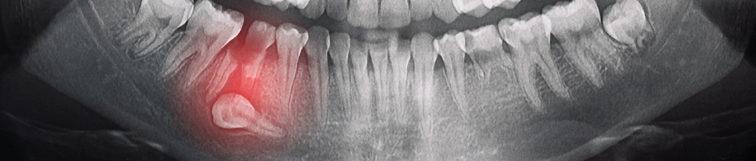 manque place dents scaled Dents incluses, anomalie du nombre de dent : dent en moins ( agénésie ), dent en trop ( surnuméraire ) Orthodontiste Altkirch | Dr Marie Saive & Dr Olivier Saive
