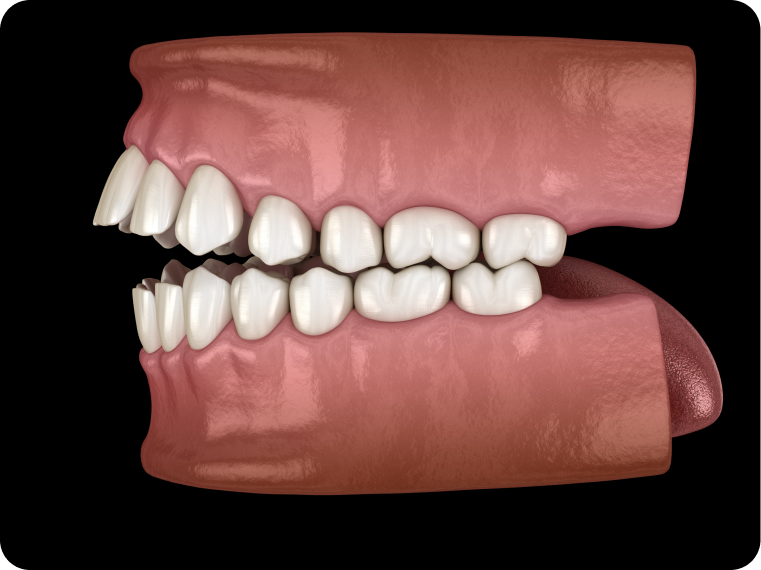 occlusion croisee orthosaive orthodontie occlusion croisee orthosaive orthodontie Incisives supérieures trop en avant, habitude de succion persistante, béance incisive, morsure palatine Orthodontiste Altkirch | Dr Marie Saive & Dr Olivier Saive