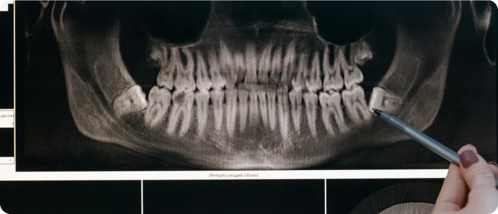 orthopedie dento faciale altkirch orthopedie dento faciale altkirch Incisives supérieures trop en avant, habitude de succion persistante, béance incisive, morsure palatine Orthodontiste Altkirch | Dr Marie Saive & Dr Olivier Saive