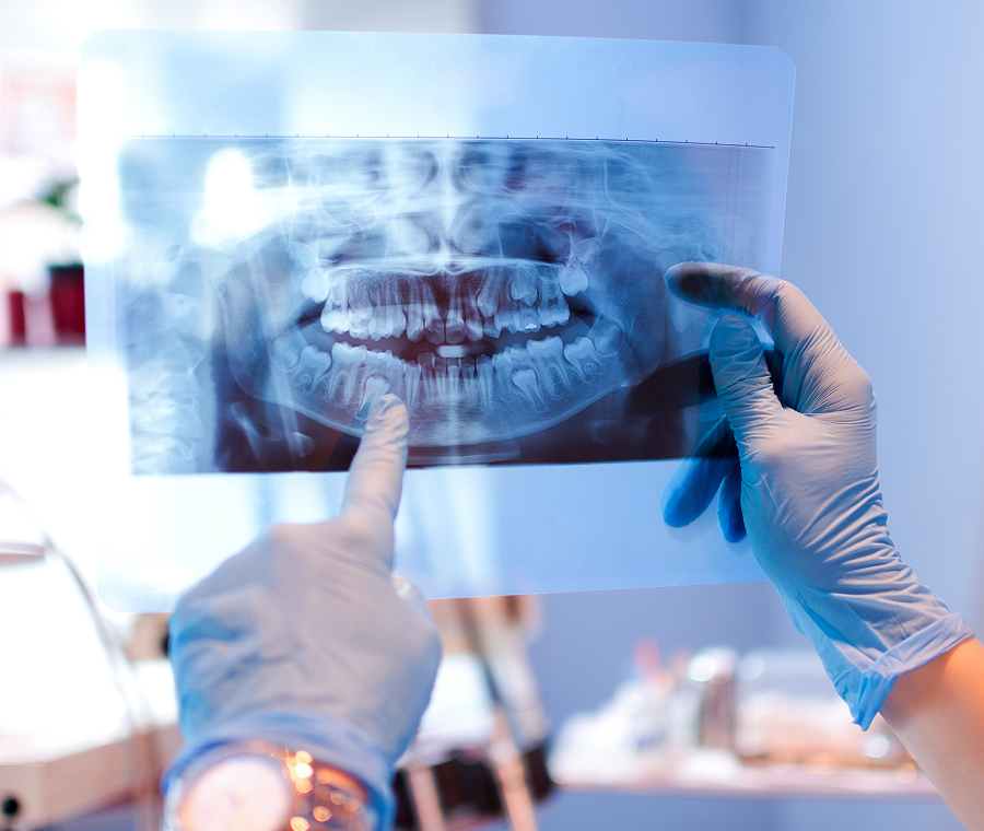 orthosaive orthodontiste Dents incluses, anomalie du nombre de dent : dent en moins ( agénésie ), dent en trop ( surnuméraire ) Orthodontiste Altkirch | Dr Marie Saive & Dr Olivier Saive