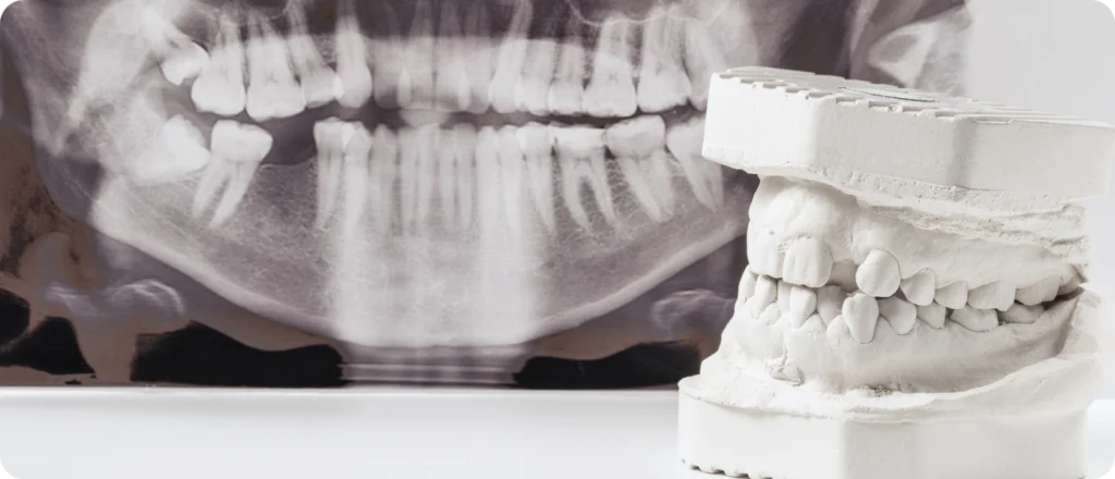 succion tetine orthosaive orthodontie succion tetine orthosaive orthodontie Dents incluses, anomalie du nombre de dent : dent en moins ( agénésie ), dent en trop ( surnuméraire ) Orthodontiste Altkirch | Dr Marie Saive & Dr Olivier Saive