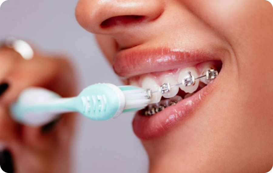 systeme lingual altkirch orthodontiste systeme lingual altkirch orthodontiste Encombrement dentaire, arcade dentaire étroite, manque de place Orthodontiste Altkirch | Dr Marie Saive & Dr Olivier Saive