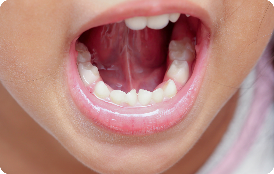 trouble occlusion altkirch orthodontie trouble occlusion altkirch orthodontie Incisives supérieures trop en avant, habitude de succion persistante, béance incisive, morsure palatine Orthodontiste Altkirch | Dr Marie Saive & Dr Olivier Saive