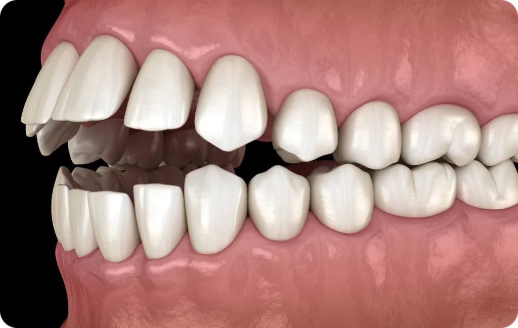 aligneurs transparents orthodontie orthosaive aligneurs transparents orthodontie orthosaive Traitement d’interception Orthodontiste Altkirch | Dr Marie Saive & Dr Olivier Saive