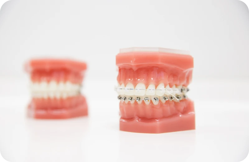 attaches appareils amovibles orthodontie orthosaive ceramiques attaches appareils amovibles orthodontie orthosaive ceramiques Appareil dentaire métallique et céramique Orthodontiste Altkirch | Dr Marie Saive & Dr Olivier Saive