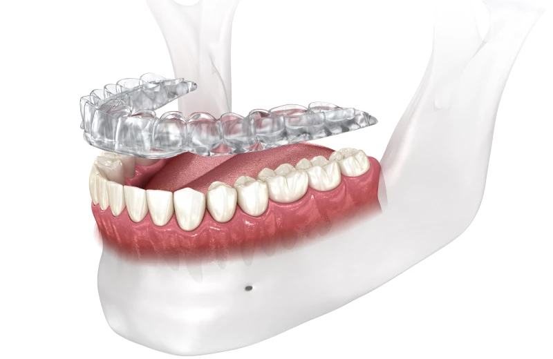 gouttieres transparentes orthodontiste gouttieres transparentes orthodontiste Traitement des troubles articulaires Orthodontiste Altkirch | Dr Marie Saive & Dr Olivier Saive