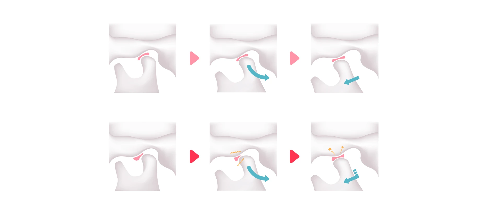 orthese anti ronflement orthese anti ronflement Traitement des troubles articulaires Orthodontiste Altkirch | Dr Marie Saive & Dr Olivier Saive