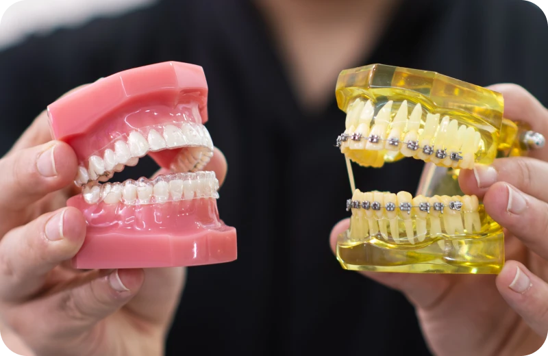 traitement troubles articulaires altkirch traitement troubles articulaires altkirch Gouttières transparentes Orthodontiste Altkirch | Dr Marie Saive & Dr Olivier Saive