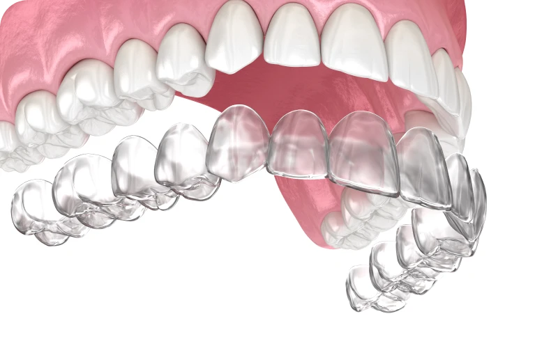 orthodontie adulte altkirch cabinet orthodontie adulte altkirch cabinet Contention orthodontique Orthodontiste Altkirch | Dr Marie Saive & Dr Olivier Saive