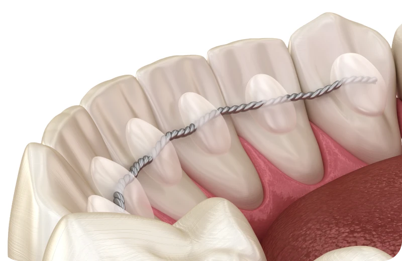 traitement interception orthodontie orthosaive traitement interception orthodontie orthosaive Contention orthodontique Orthodontiste Altkirch | Dr Marie Saive & Dr Olivier Saive